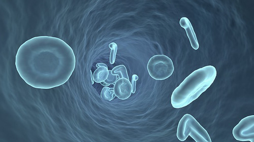 キレーションにより血管内腔を広げます