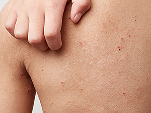 アトピー性皮膚炎