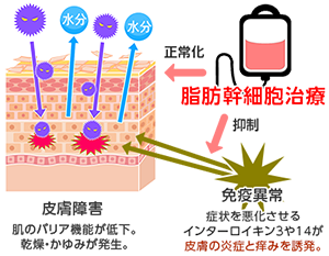 難治性アトピー性皮膚炎は脂肪幹細胞による治療で！